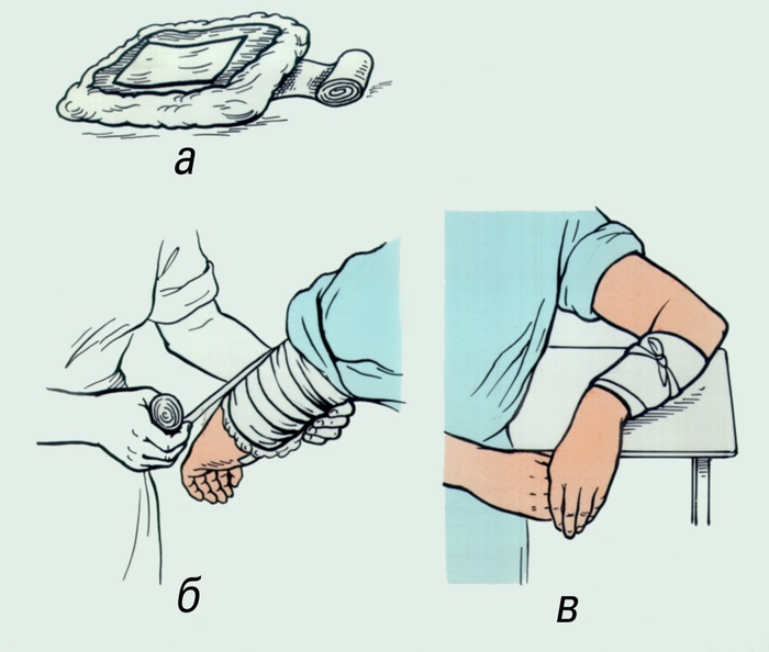 Техника наложения согревающего компресса: а — комплект необходимых материалов; б — наложение бинта; в — общий <a href=