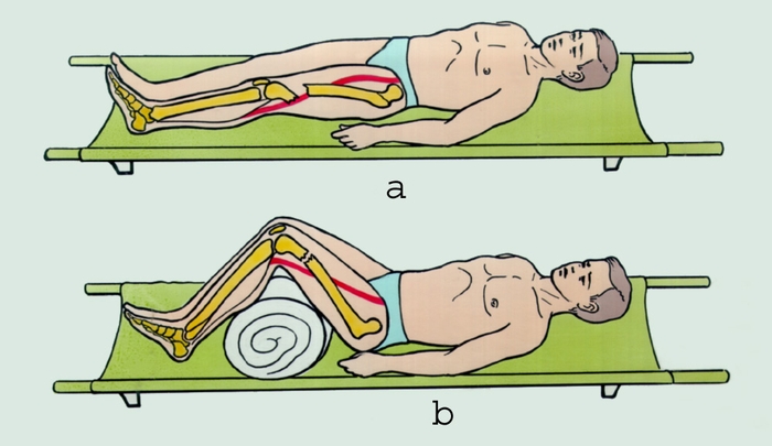 Рис. 3. Укладка пострадавшего с переломом бедренной кости: а — неправильная укладка; б — правильная укладка (<a href=