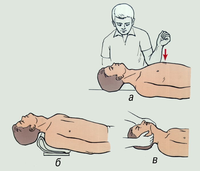 Рис. 3. Некоторые реанимационные мероприятия: а — восстановление сердечной деятельности путем удара кулаком в область сердца (средняя треть грудины); б — запрокидывание головы; в — выдвижение нижней челюсти