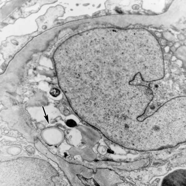 Рис. 6в). Электронограмма почки при фокальном сегментарном гломерулярном гиалинозе — в цитоплазме мезангиальных клеток содержатся липиды, указано стрелкой; ×12000