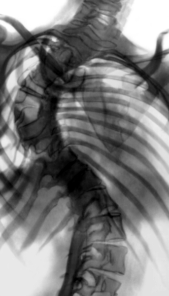 Рис. 18б). Рентгенограмма позвоночника (прямая проекция) при правостороннем грудном сколиозе IV степени после частичной коррекции деформации и заднего спондилодеза