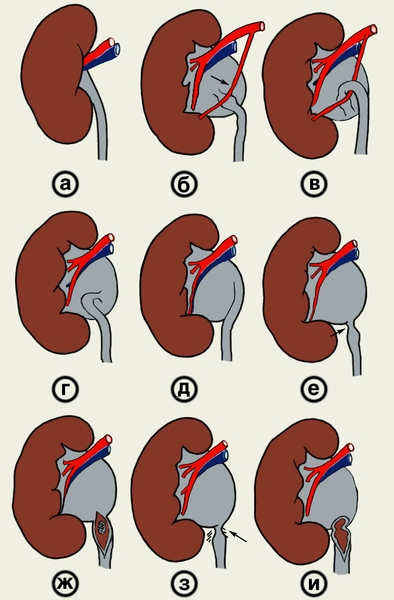 Рис. 3. Схематическое изображение почек при различных нарушениях проходимости в лоханочно-мочеточниковом сегменте, способствующих возникновению гидронефроза: а — нормальная почка (для сравнения); б — добавочный <a href=