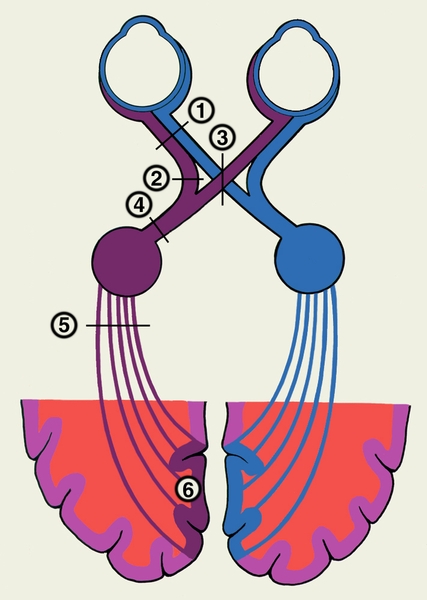 Рис. 1. Схема поражений зрительного пути на различных уровнях (обозначены цифрами), вызывающих нарушение зрения: 1 — поражение зрительного нерва (<a href=