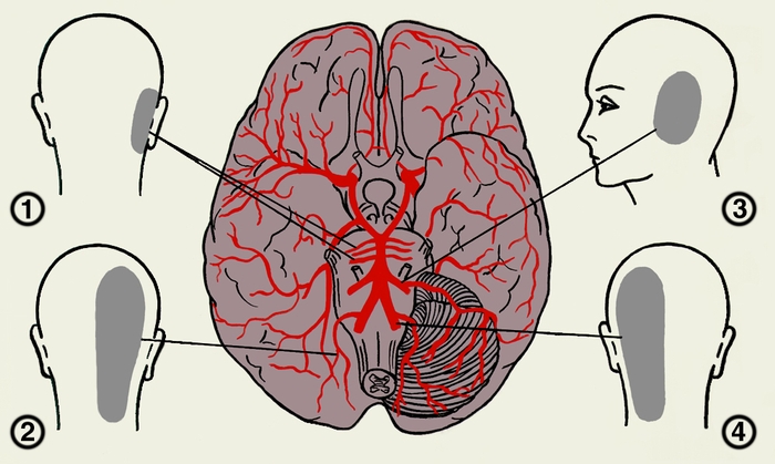 Рис. 5б). Зоны проекции боли при раздражении артерий основания мозга: 1 — артерий моста мозга; 2 — слуховой артерии; 3 — задней мозжечковой артерии; 4 — позвоночной артерии