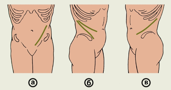 Рис. 9. Схематическое изображение кожных разрезов при люмботомии: а — по Чаклину; б — по Федорову (вверху) и Бергманну — Израэлю (внизу); в — по Саутвику — Робинсону