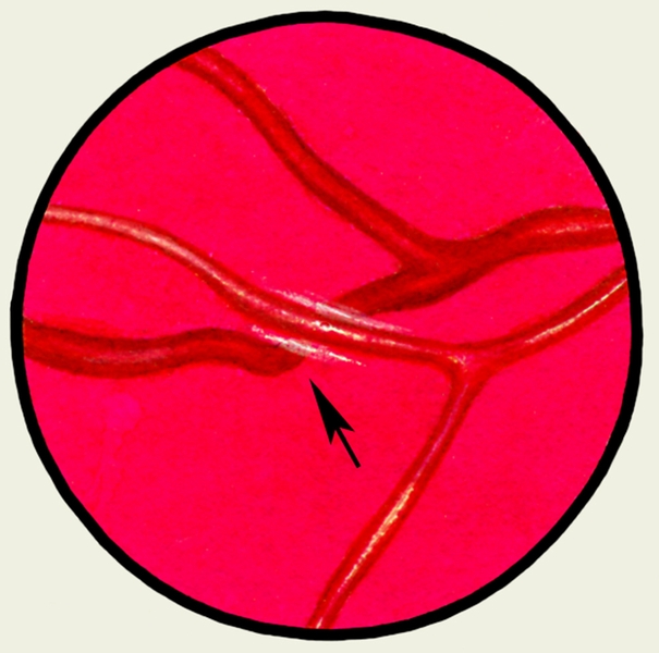 Рис. 11. Глазное дно в норме и при патологии. Изменения сосудов сетчатки при гипертонической болезни: стрелкой указана вена, которая в месте перекреста с артерией становится невидимой (как бы разрывается) вследствие ее смещения в глубь сетчатки (<a href=