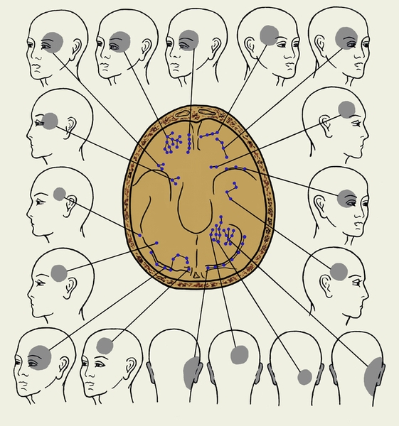 Рис. 3. Зоны проекции боли на поверхность головы при раздражении твердой мозговой оболочки на основании черепа