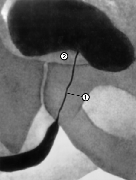 Рис. 2. Восходящая уретроцистограмма при аденоме предстательной железы: 1 — суженная предстательная часть уретры; 2 — <a href=
