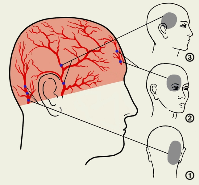 Рис. 2. Зоны проекции боли на поверхность головы при раздражении затылочной артерии (1), лобной артерии (2), поверхностной височной артерии (3)