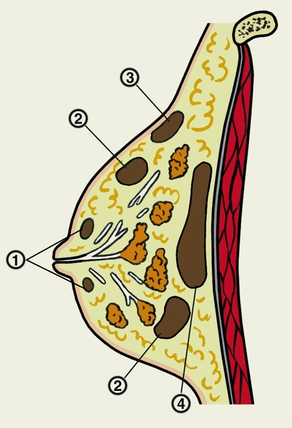 Рис. 1. Схематическое изображение молочной железы на разрезе при гнойном мастите с различной локализацией процесса: 1 — субареолярный мастит; 2 — интрамаммарный мастит; 3 — подкожный мастит; 4 — ретромаммарный мастит