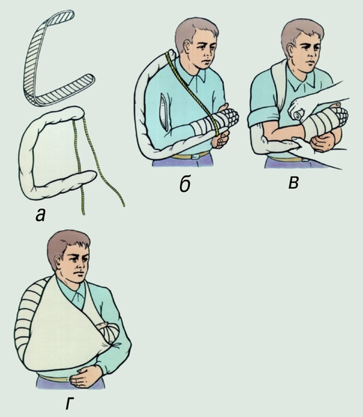 Рис. 4. Иммобилизация при повреждениях плеча и локтевого сустава: а — подготовка лестничной шины: б — наложение шины; в — фиксация шины бинтом; г — подвешивание верхней конечности на косынке