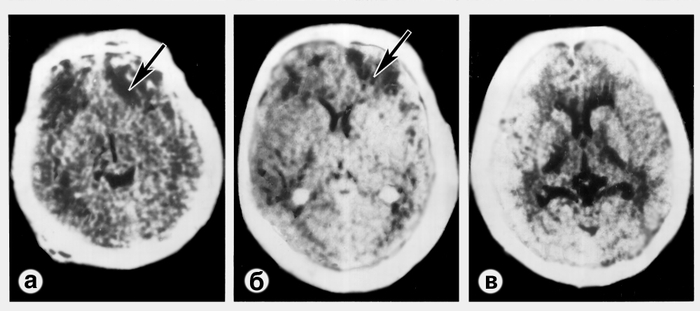 Рис. 1. Компьютерные томограммы при тяжелом ушибе левой лобной доли (а, б) и диффузном аксональном повреждении мозга (в): а — очаговое <a href=
