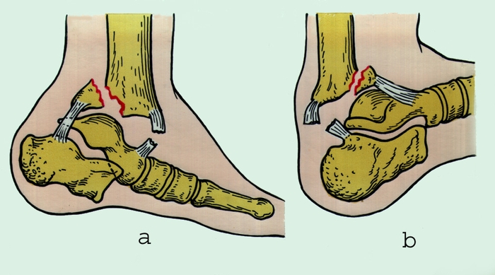 Рис. 4. Варианты перелома большеберцовой кости в области голеностопного сустава: а — перелом заднего края большеберцовой кости с вывихом стопы кзади; б — перелом переднего края большеберцовой кости с подвывихом стопы кпереди