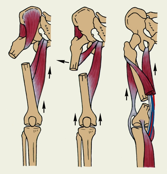 Рис. 5. Схематическое изображение типичных смещений отломков бедренной кости в зависимости от уровня перелома. Стрелками показаны направления смещения, обусловленные тягой мышц