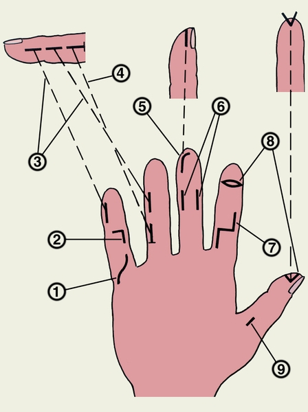 Рис. 13. Разрезы, рекомендуемые для вскрытия гнойных процессов на пальцах: 1, 2, 7 — разрезы по ладонной поверхности фаланг пальца; 3, 9 — среднелатеральные разрезы; 4 — Т-образный разрез; 5 — клюшкообразный, полулунный разрез; 6 — парные переднебоковые разрезы; 8 — поперечный эллипсообразный разрез с иссечением краев раны