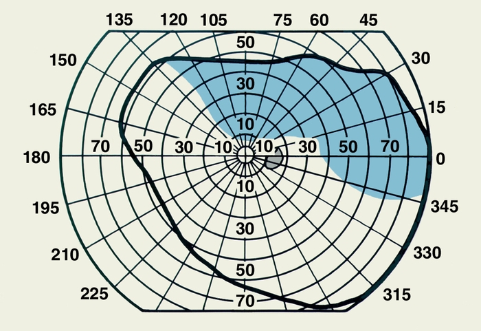 Рис. 2в). Схема поля зрения, полученная при периметрии левого глаза с использованием белого тест-объекта (выпавшие участки обозначены голубым цветом): при отслойке сетчатки в нижненосовом квадранте; серым цветом закрашено слепое пятно
