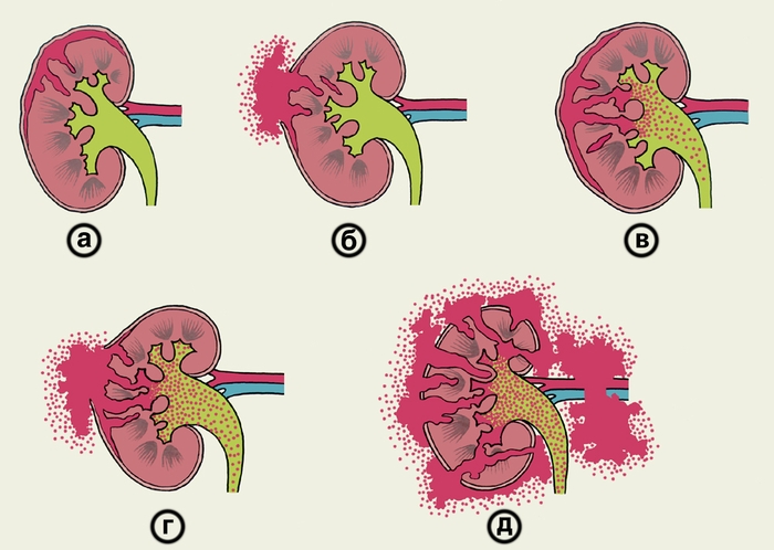 Рис. 9. Схематическое изображение разных видов закрытых повреждений почки: а и б — разрывы и гематомы, не проникающие в почечные чашечки и лоханку (а — без разрыва, б — с разрывом фиброзной капсулы); в и г — повреждения, проникающие в чашечки и лоханку (в — без разрыва фиброзной капсулы, г — с разрывом фиброзной капсулы); д — размозжение почки
