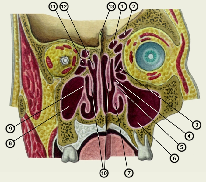 Рис. 2. Схематическое изображение полости носа и придаточных пазух (фронтальные распилы): 1 — передняя ячейка решетчатой кости; 2 — лобная пазуха; 3 — средняя ячейка решетчатой кости; 4 — отверстие верхнечелюстной пазухи в полулунную расщелину; 5 — <a href=