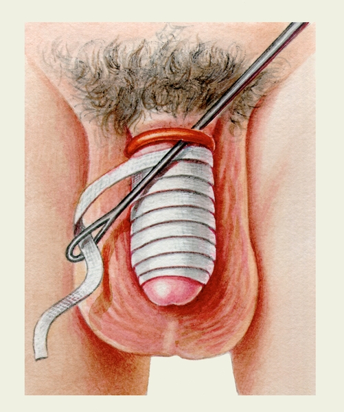 Рис. 6а). Удаление ущемляющего кольца с полового члена по Хартманну: наматывание узкой ленты на головку и тело полового члена до ущемляющего кольца, проведение проксимального конца ленты в ушко тупой иглы, подведение иглы под кольцо