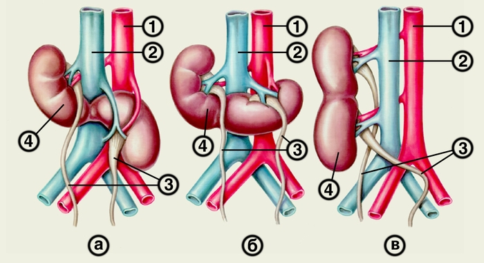 Рис. 5. Схематическое изображение почек с асимметричными формами сращения: а — S-образная почка; б — L-образная почка; в — I-образная почка; 1 — брюшная <a href=