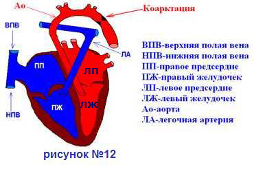 Коарктация аорты