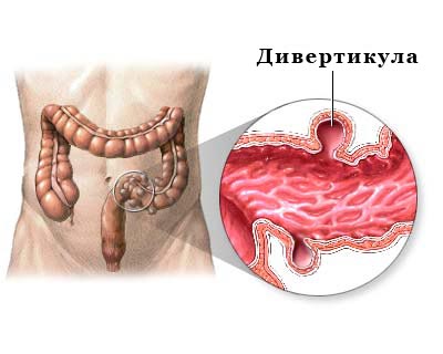 Дивертикулярная болезнь (дивертикулез)