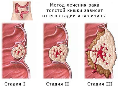 Колоректальный рак