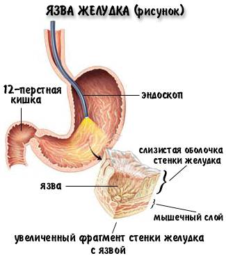 Язва желудка